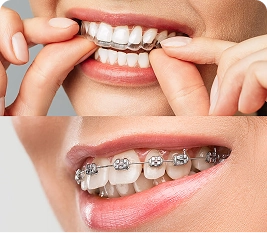 តម្រឹមធ្មេញ & Invisalign®