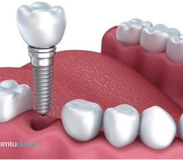 Implant តែមួយ