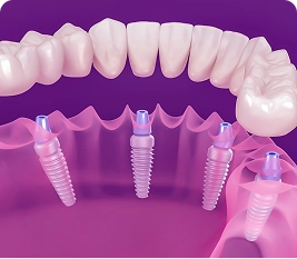 Implant ទាំងមាត់