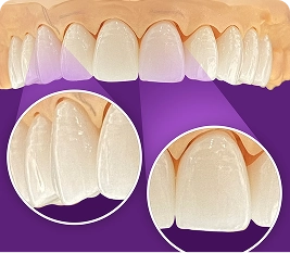 មកុដធ្មេញសេរ៉ាមិចសម្ផស្ស