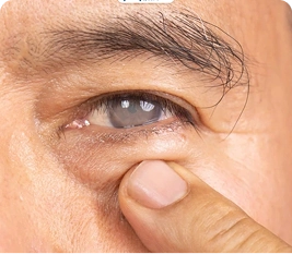 វះកាត់ Glaucoma