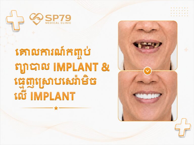 ផ្ទាំងបដាគោលការណ៍កញ្ចប់ព្យាបាល Implant នៅ SP79